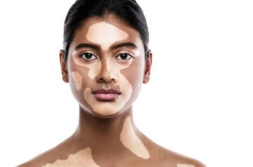 Why Psychological Counseling is Important for Vitiligo Patients