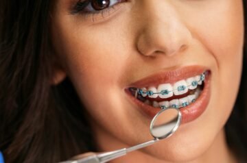 How Much Are Braces? Plus Tips to Make Them More Affordable