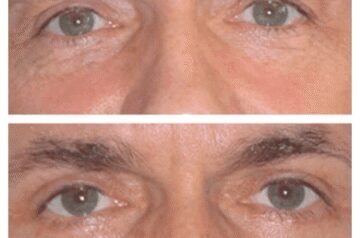 Before You Book: Eye Bag Removal Consultations with the Best Doctors in Dubai
