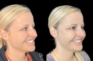 Latest Trends in Botox in Jeddah