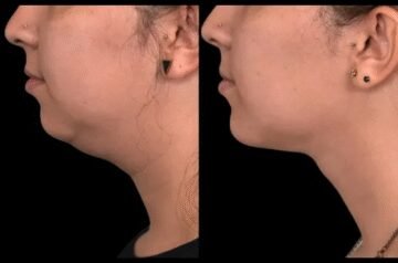 Double Chin Removal for Quick Transformations: Advice from the Best Doctors in Dubai