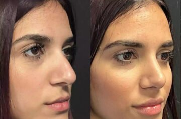 International Patients Seeking Septoplasty in Dubai: A Travel Guide