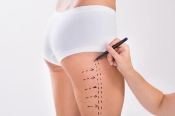 First Meeting to Final Results with Best Liposuction Surgeon in Dubai