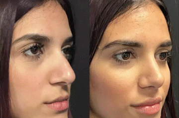 Best Rhinoplasty Surgeon in Dubai for a Natural, Balanced Nose