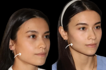 Why the Best Aesthetic Clinics in Dubai Are Embracing Sculptra Fillers