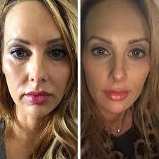 Rejuvenate Your Look with the Best Plastic Surgeon in Dubai for Thread Lift