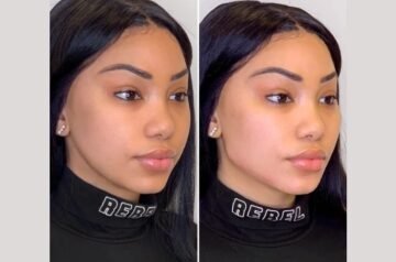 What to Expect Before, During, and After Your Thread Lift at the Best Aesthetic Clinic in Dubai