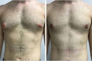 Gynecomastia Surgery in Dubai: Before and After Transformation Stories
