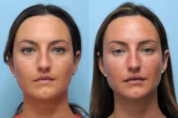 Elevate Your Beauty and Rejuvenate Your Appearance Through Thread Lift Treatments in Dubai