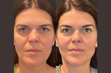 Best Plastic Surgeons in Dubai for Minimally Invasive Thread Lift Procedures