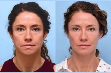 Best Aesthetic Clinics in Dubai Provide Affordable High Quality Thread Lift Treatment Options
