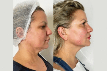 Best Doctors in Dubai for J-Plasma Treatments