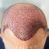 FUT Hair Transplant ...