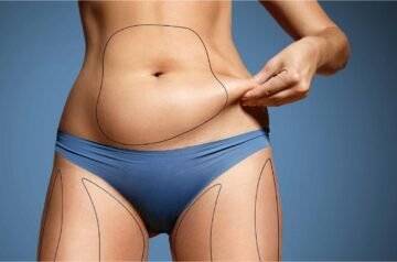 Abdominoplasty in Dubai for Post-Pregnancy Transformation