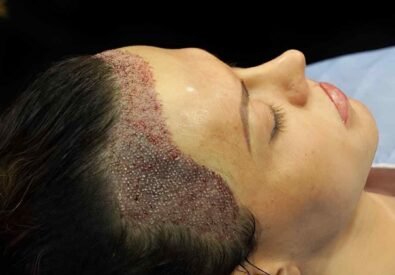 FUE Hair Transplant ...