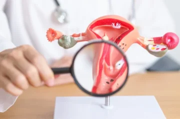 Fibroids Treatment in Lucknow