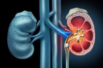 Kidney Stone Symptoms: When to See a Urologist